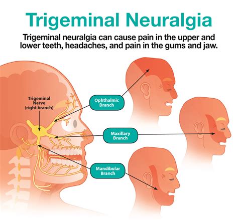 What Causes Neuralgia Of The Teeth - TeethWalls