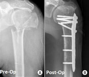 Shoulder Fracture Causes & Treatment - Shoulder Pain Explained