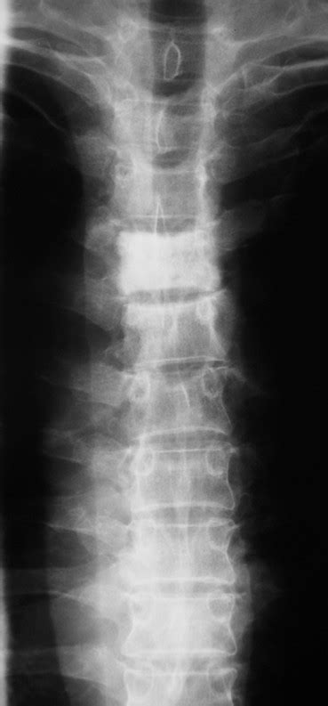 AP X ray of Thoracic spine. | Open-i