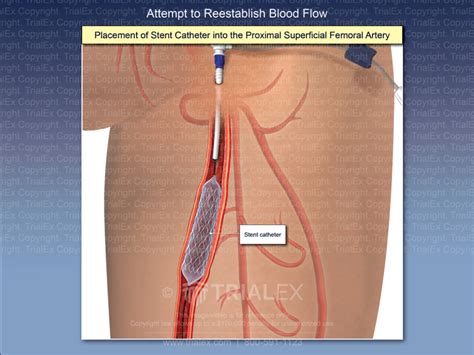 Placement of Stent Catheter into the Proximal Superficial Femoral ...