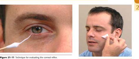 Test Corneal Reflex - Physical Diagnosis - Mitch Medical