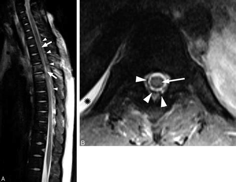 Thoracic spine MR imaging. A, Sagittal T2-weighted MR image of the ...