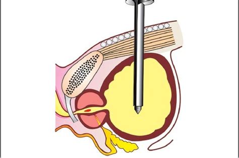 emDOCs.net – Emergency Medicine EducationSuprapubic Catheter ...