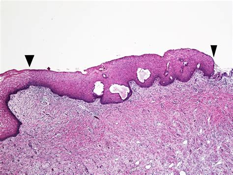 Pathology Outlines Squamous Metaplasia