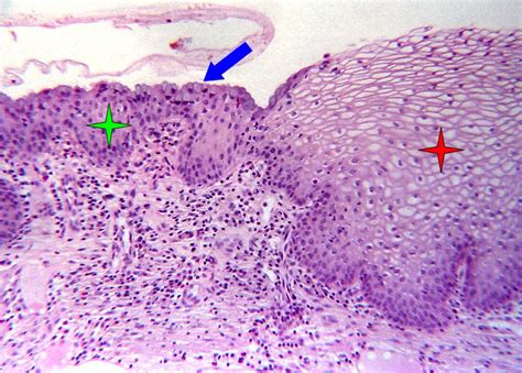 Histopathology Of The Uterine Cervix Digital Atlas