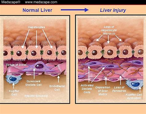 Hepatic Stellate Cell In Fibrosis