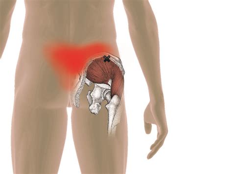 gluteus medius trigger points