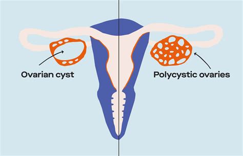 what s the difference between ovarian cysts and pcos