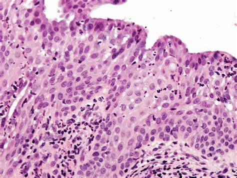 Pathology Outlines Squamous Metaplasia