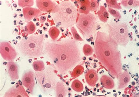 Lm Of Cervical Cells Showing Squamous Metaplasia Stock