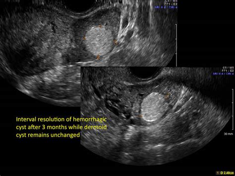 hemorrhagic ovarian cysts one entity with many appearances mdedge obgyn