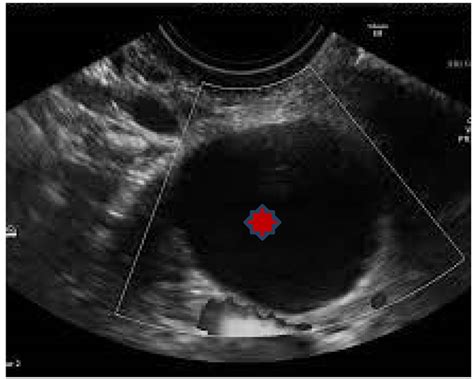 place of doppler ultrasound in the characterization of ovarian cysts