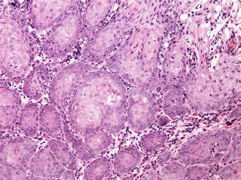 Pathology Outlines Squamous Metaplasia