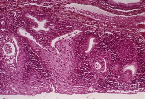 Cervical Squamous Metaplasia Photograph By Dr F Coupez Cnri