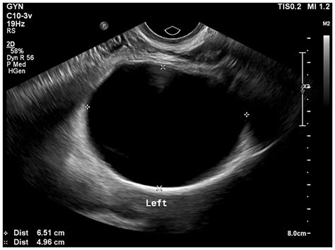 frontiers tarlov cysts misdiagnosed as adnexal masses in pelvic