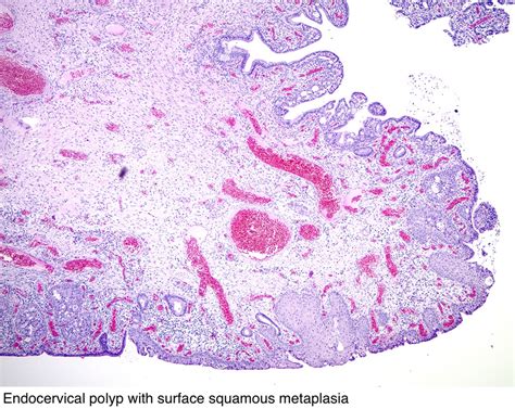 Pathology Outlines Endocervical Polyp