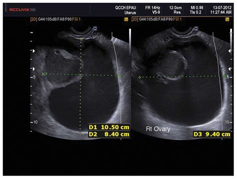 the characteristic ultrasound features of specific types of ovarian