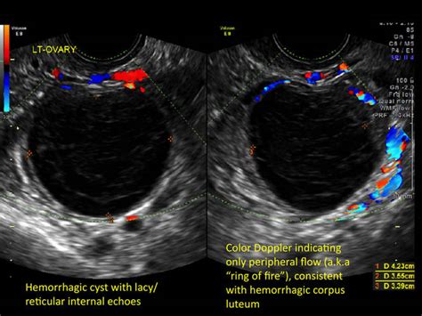 hemorrhagic ovarian cysts one entity with many appearances mdedge obgyn