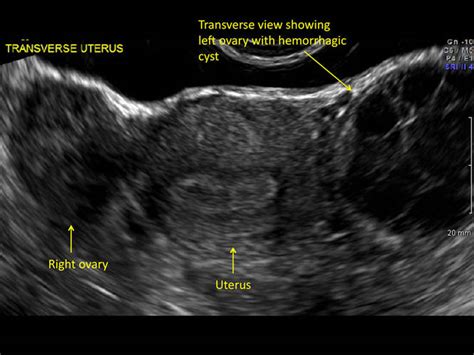 hemorrhagic ovarian cysts one entity with many appearances mdedge obgyn