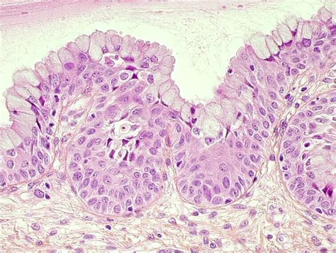 Histopathology Of The Uterine Cervix Digital Atlas