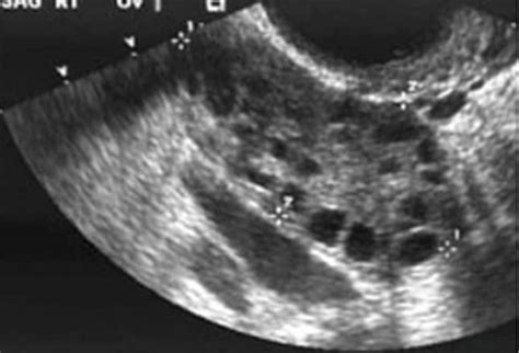 ovarian cysts functional or neoplastic benign or malignant