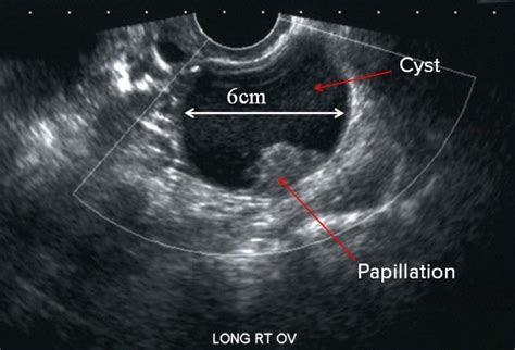 ovarian cysts functional or neoplastic benign or malignant