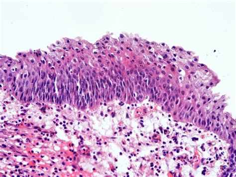 Squamous Metaplasia He Stain ×200 Download