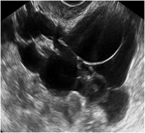 the characteristic ultrasound features of specific types of ovarian