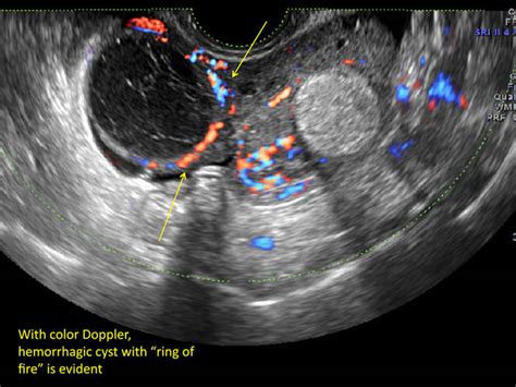 hemorrhagic ovarian cysts one entity with many appearances mdedge obgyn