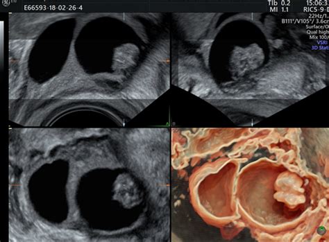 management of ovarian cystic tumor diagnosis management and its