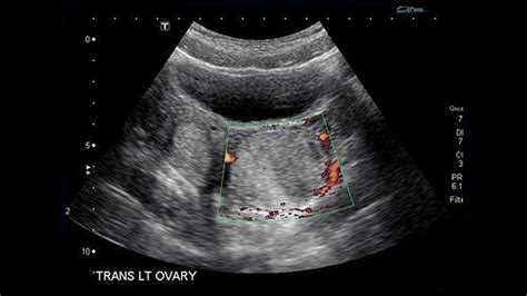 simple ovarian cysts on ultrasound need no further monitoring