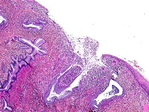 Chronic Cervicitis With Squamous Metaplasia Iammrfoster