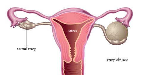 cysts on ovaries causes symptoms treatment prevention