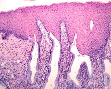 Squamous Metaplasia Of Endocervix Photograph By Jose Calvo