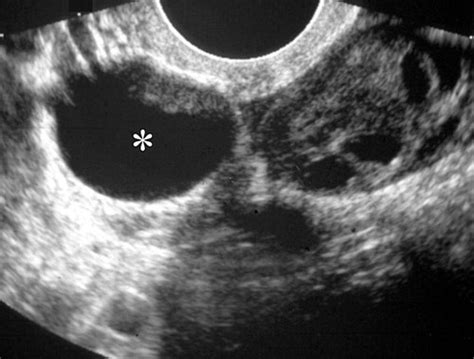 us of the ovary and adnexa to worry or not to worry radiographics