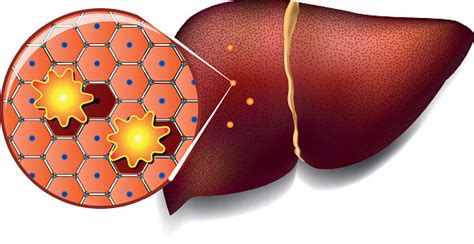 Liver Cells Attacked By Toxins Stock Illustration Download Image Now