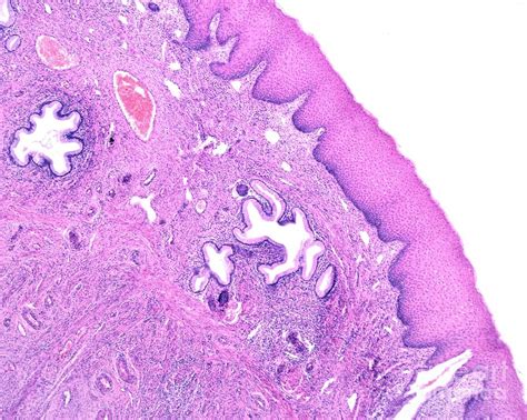 Squamous Metaplasia Of Endocervix Photograph By Jose Calvo