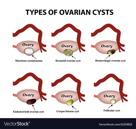 types of ovarian cysts set infographics royalty free vector