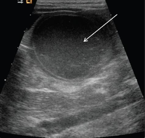 hemorrhagic ovarian cyst longitudinal view of the pelv open i