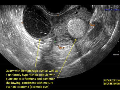 hemorrhagic ovarian cysts one entity with many appearances mdedge obgyn