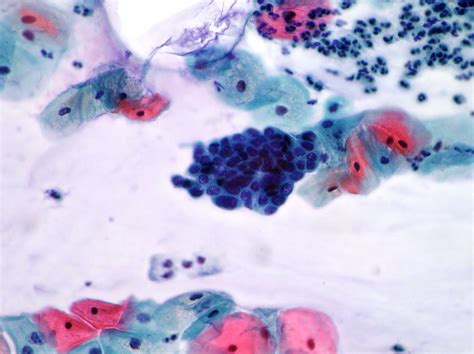 Uterine Cervix Cytopathology Cellnetpathology