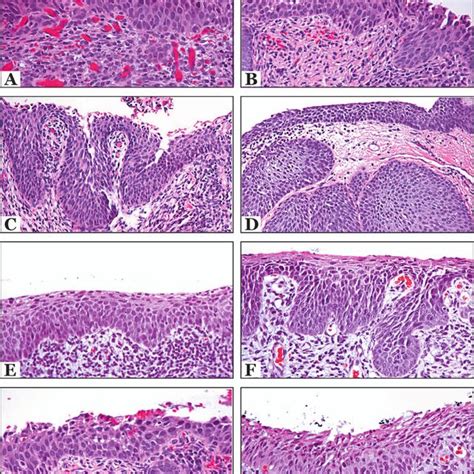 Pdf P16 And Ki 67 Immunostaining In Atypical Immature