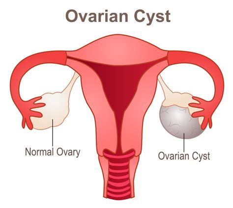 ovarian cystectomy remove that troublesome cyst sitaram bhartia blog