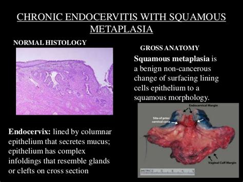 Chronic Endocervitis With Squamous Metaplasia