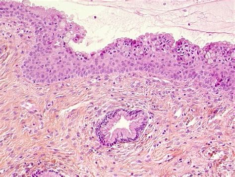 Histopathology Of The Uterine Cervix Digital Atlas