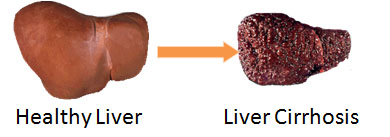 Liver cirrhosis; Cirrhosis, Liver; Hepatic Cirrhosis; Liver Fibrosis ... image.