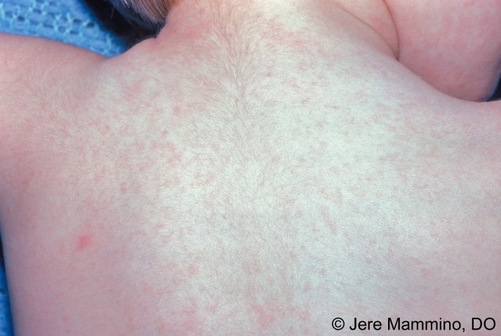 roseola rash on face