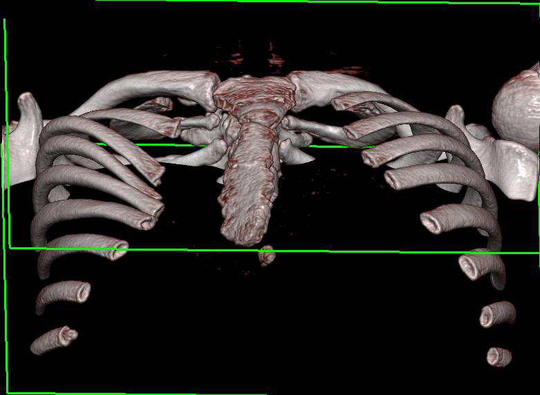 3D Mapping for Pre-Operative Pectus Repair - CTisus CT Scan