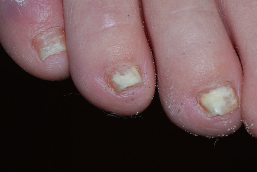 Fungal nail infection: MedlinePlus Medical Encyclopedia