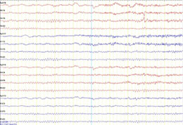 Normal EEG